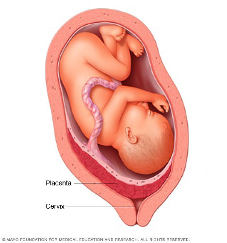 https://www.mayoclinic.org/diseases-conditions/placenta-previa/symptoms-causes/syc-20352768