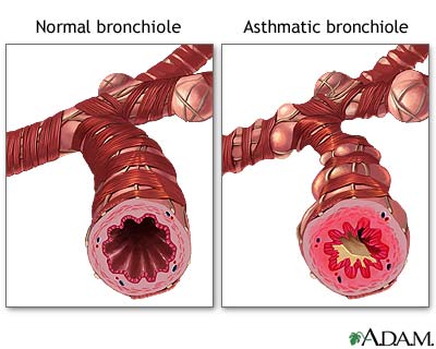 if the bronchioles are dilated the anatomic dead space