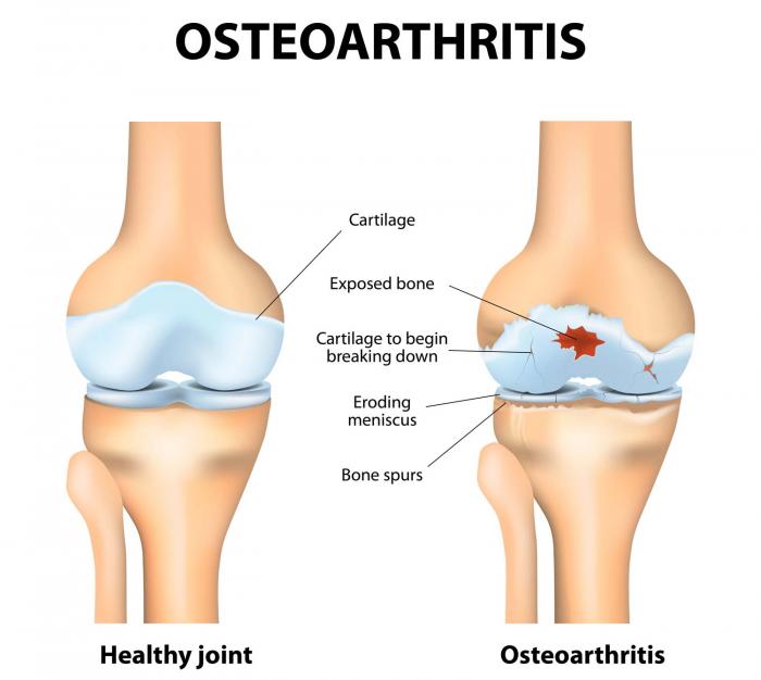 http://www.medicalnewstoday.com/content/images/articles/027/27871/diagram-of-osteoarthritis-in-knee-joint.jpg