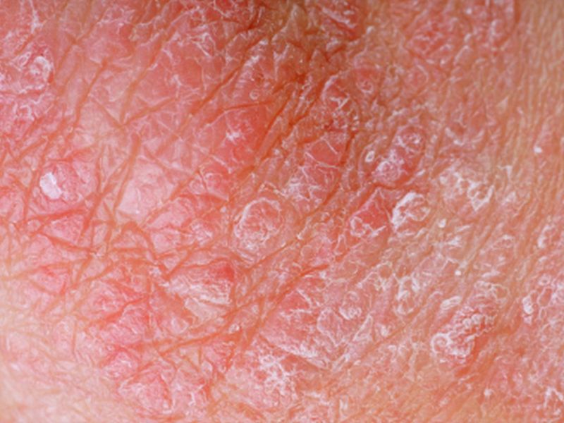 http://canacopegdl.com/keyword/skin-diseases.html
