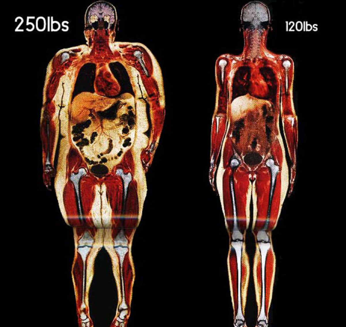 Толстый человек анатомия. Широкая кость. Полный скелет человека. Скелет полного и худого человека. Люди с широкими костями.