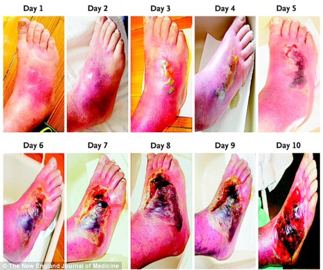 http://www.dailymail.co.uk/health/article-2518628/The-shocking-images-reveal-diabetes-feet-just-10-DAYS.html