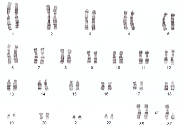 http://study.com/academy/lesson/karyotype-definition-disorders-analysis.html