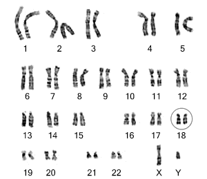 Chromosome 18 Registry and Research Society