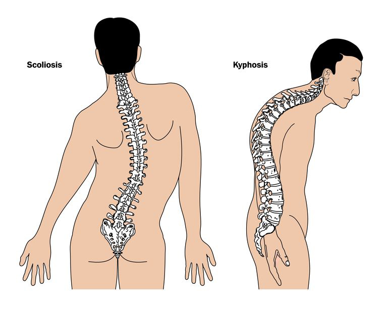 https://www.spineuniverse.com/conditions/kyphosis