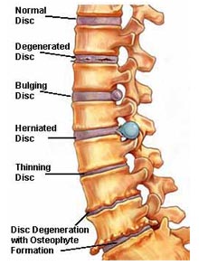 http://www.financegy.com/uncategorized/lower-back-stretches-for-slipped-disc.html