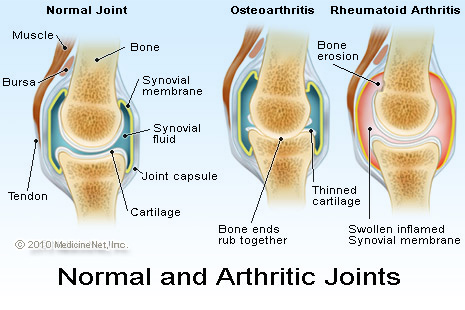 http://upachaya.com/wp-content/uploads/2014/08/arthritic_jointsjpg
