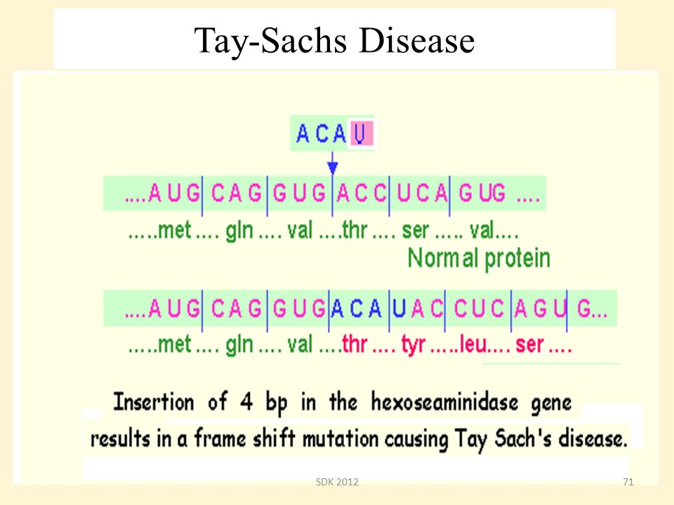 http://slideplayer.com/7933614/25/images/71/Tay-Sachs+Disease+SDK+2012jpg