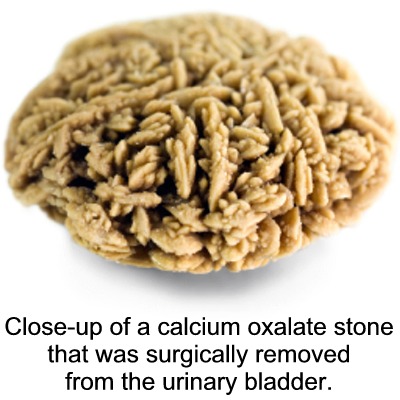 http://pixshark.com/calcium-oxalate-stones.htm