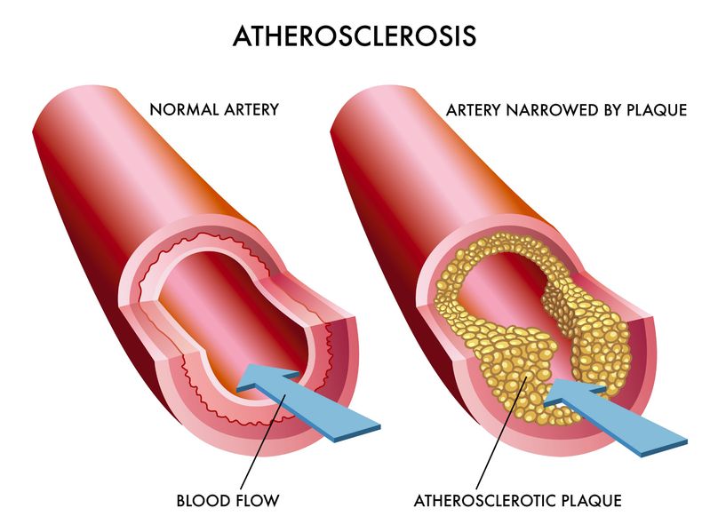 https://www.azvascular.com/atherosclerosis/